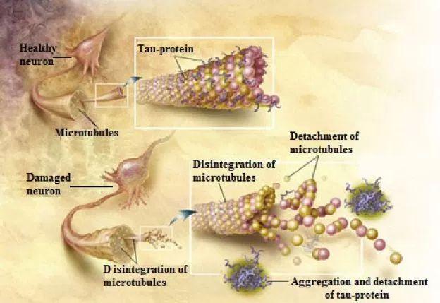 Alzheimer s disease - an overview INSIDE OF CELLS: NEUROFIBRILLARY TANGLES Neurofibrillary tangles: Bundles of filaments in cytoplasm of neurons that displace or encircle the nucleus.