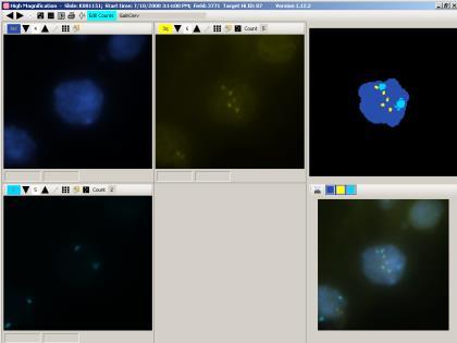 CELL EXHIBITING 3q GAIN FISH analysis of a liquid cytology specimen using probes for chromosome 3q26 (Gold) and chromosome 7 (Aqua) CASE STUDY Index Cytology: ASCUS HPV52 positive Colposcopy
