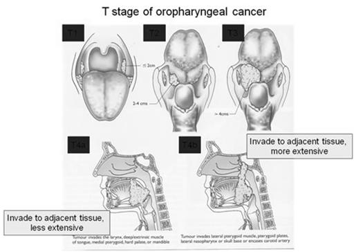 Two Routes to Head and Neck SCC Cancer HPV-positive HPV-negative Anatomic site Tonsil / BOT All sites Histology Age Gender Social-economics Risk factors Cofactors Survival Incidence Basaloid Younger