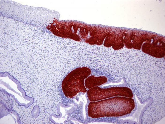 1/3 of the epithelial thickness.