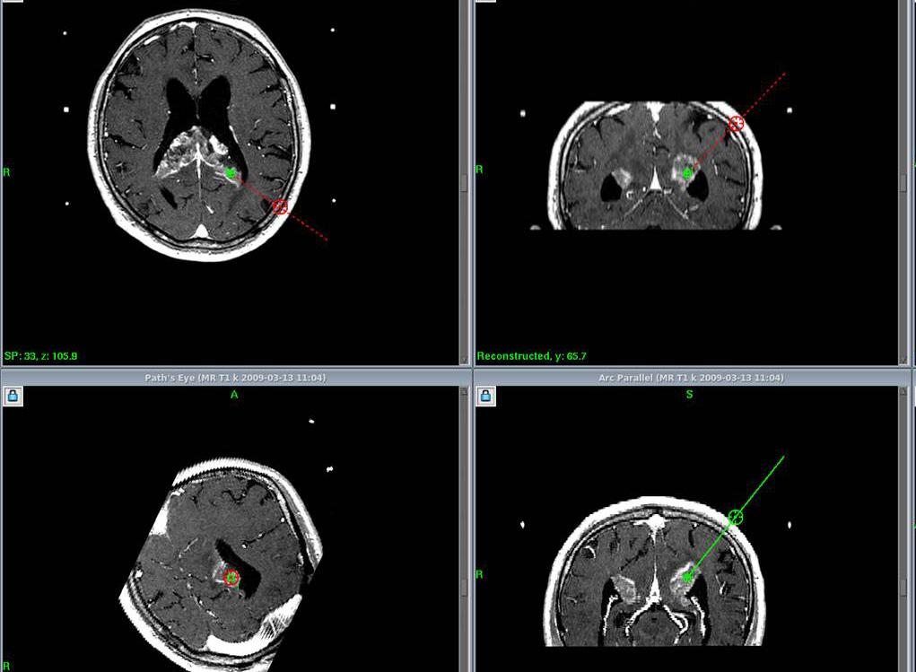 Romanian Neurosurgery (2012) XIX 2: 87 95 89 patients underwent postoperative CT scanning.