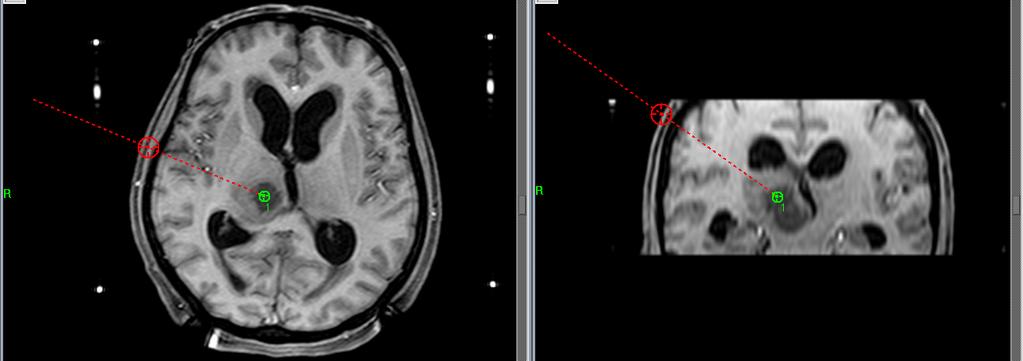 Romanian Neurosurgery (2012) XIX 2: 87 95 91 Figure 3 11 year-old girl with