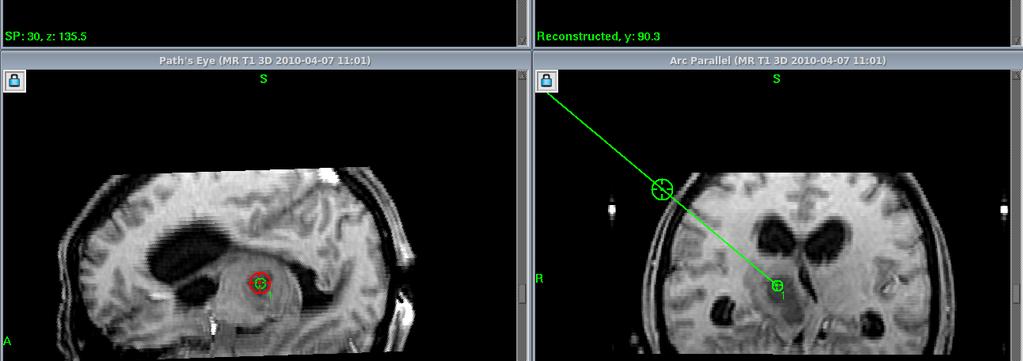 Postoperative unenhanced CT scan; Histopathological result: grade II