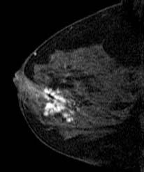 MRI GUIDED BREAST BIOPSY