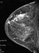 MRI GUIDED BREAST BIOPSY Advantages: allows biopsy of lesion only seen at