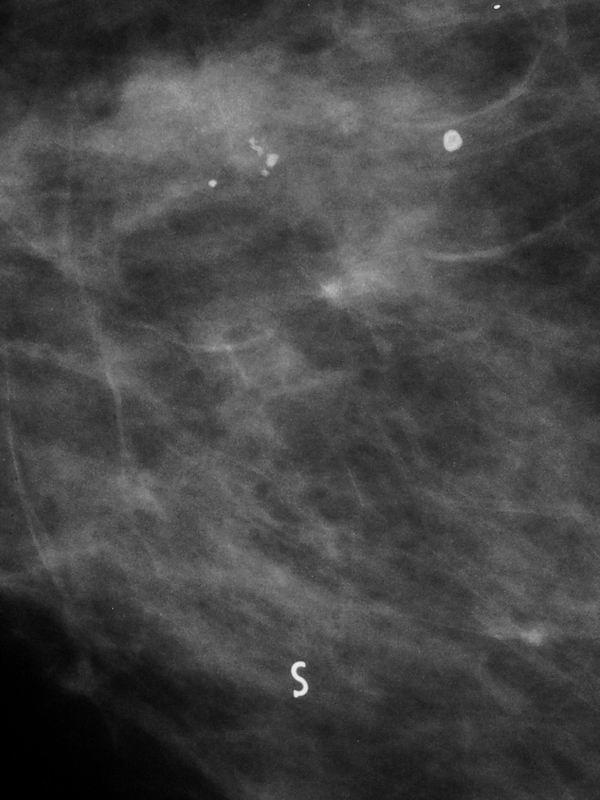 a: Pre-biopsy ML mammogram showed one area of microcalcifications (circle) with diameter of