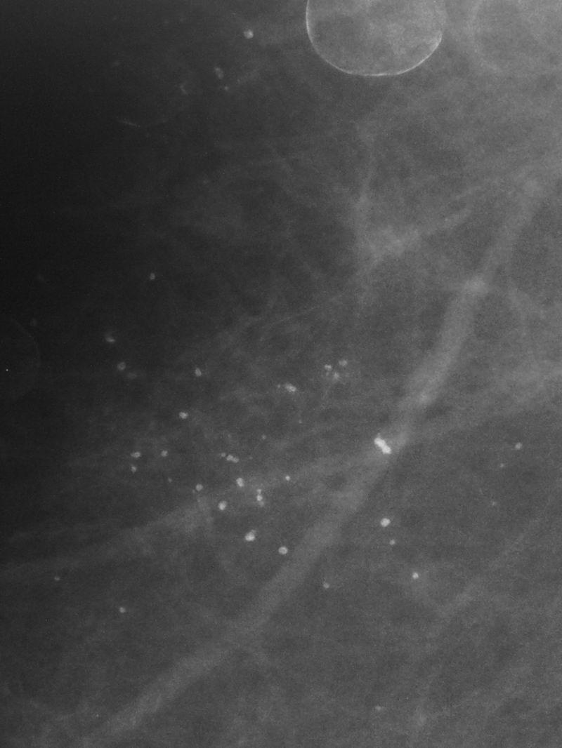 Results 18 a b c Figure 9: 76-year-old woman underwent SVAB for mono-focal microcalcifications. a: Pre-biopsy mammogram showed microcalcifications with the longest diameter of 25 mm.