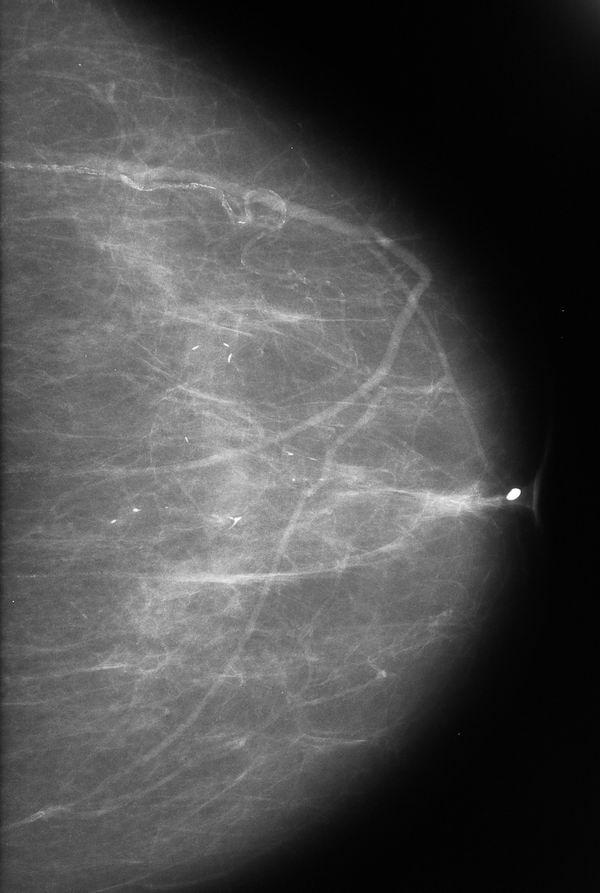 c: Post-biopsy ML mammogram shows that microcalcifications were partly removed.