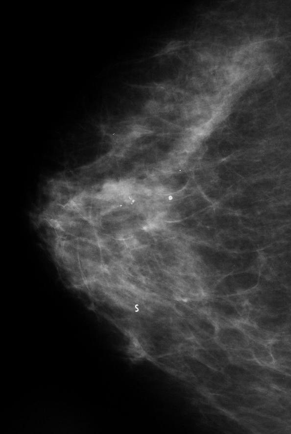(the same patient as Fig 6) a: Pre-biopsy CC mammogram showed one area of microcalcifications