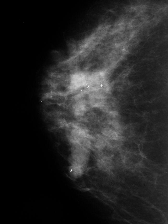 6 mm. b: Post-biopsy CC mammogram of the first biopsy.
