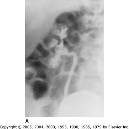 Retrograde Urography Figure 66-5 Vesicoureteral reflux in a young girl with recurrent urinary tract infections.