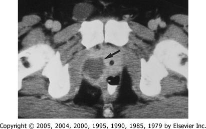 CT scan Computed tomogram demonstrating a large prostatic abscess (arrow)