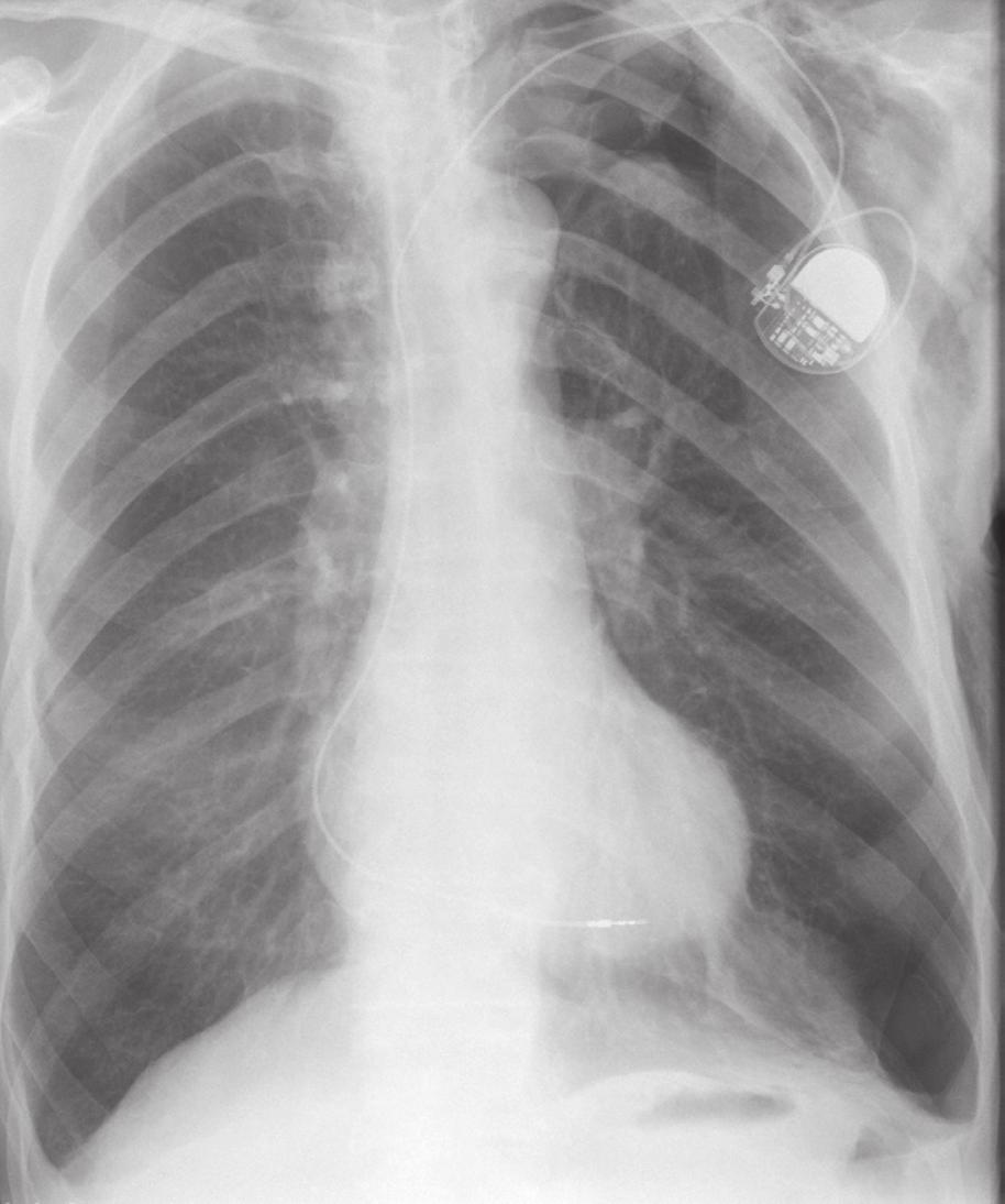 Lines and tubes Complications L Fig. 4.3 Left pneumothorax and surgical emphysema complicating single-chamber pacemaker insertion.