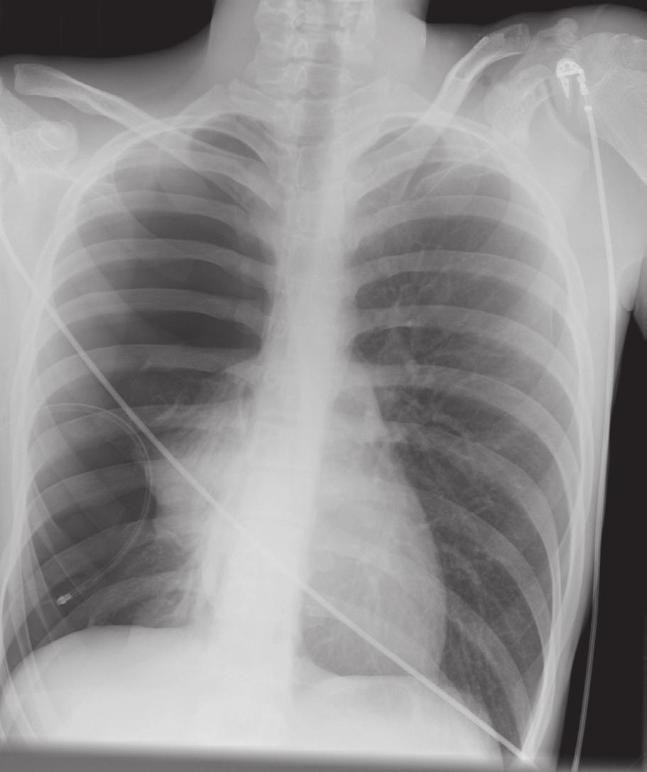 5 Chest drains R Fig. 5.1 This patient has an appropriately positioned drain within a large right pneumothorax (arrow).