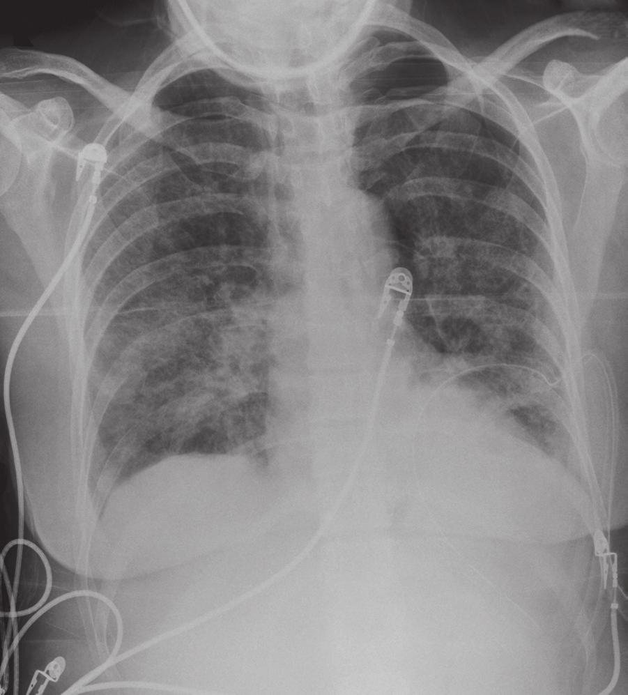 Lines and tubes R Fig. 5.4 This patient s chest drain tip has found its way into the abdomen (arrow). Follow the tube along its entire course. This is not as uncommon as you might imagine.