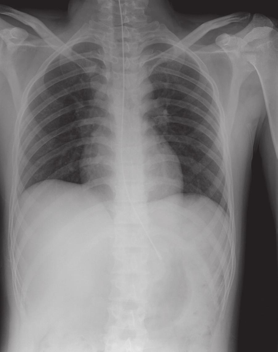 Lines and tubes Radiological features L Fig. 1.1 This patient has an appropriately positioned NG tube. This is a simple exercise in anatomy. An NG tube will go down either the oesophagus or trachea.