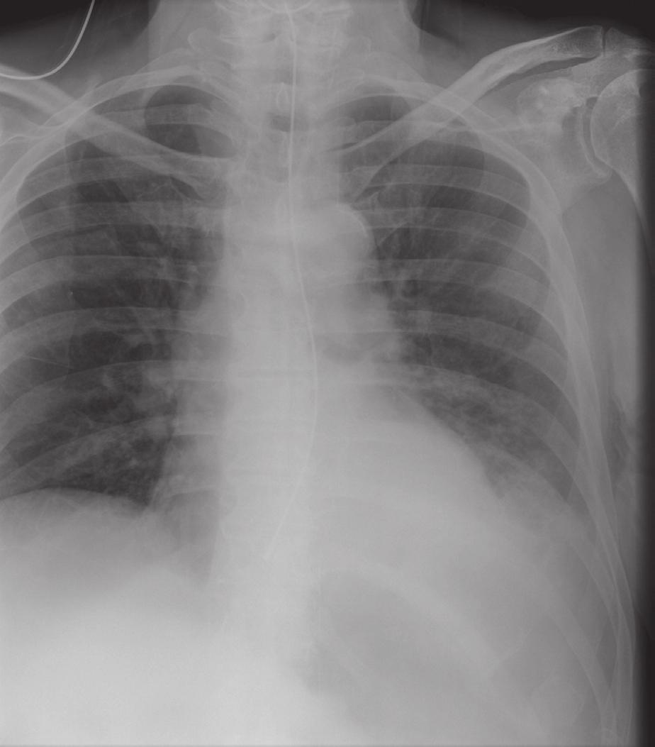 1 Nasogastric tubes L Fig. 1.2 In this patient, the NG tube is in the distal oesophagus (arrow).