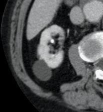 SIMPLE RENAL CYST Commonest focal