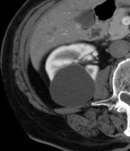 SIMPLE RENAL CYST Fully characterized also on CT - Thin wall, no calcifications
