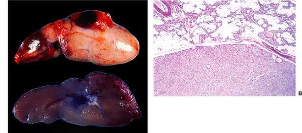 Primary hyperparathyroidism - Causes 1. Parathyroid adenoma (80-90%) mostly over 50 y.