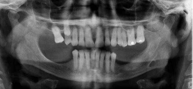 The socket was not associated with any acute symptoms such as pain or swelling, but lack of mucosal closure persisted despite local measures with his general dental practitioner.