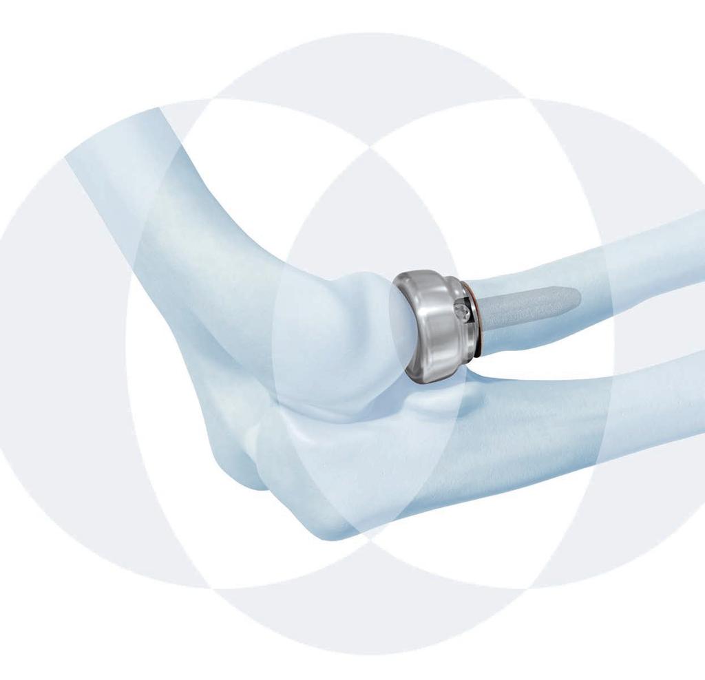 RADIAL HEAD PROSTHESIS SYSTEM For primary and revision joint replacement of the