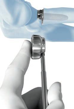 Precaution: When applying the reduction forceps to the implant head, make certain the jaws do not interfere with assembly. Using the 1.