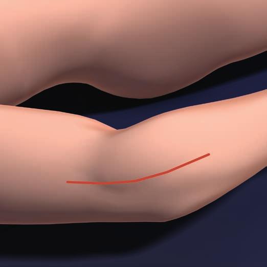 Precautions: Take care to avoid the deep branch of the radial nerve, which runs anterior to the capsule and the radial head.