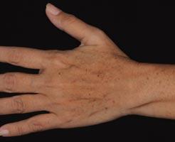 analysis enables the definition of two parameters of skin pigmentation: A luminosity parameter L* : measures the clarity of the skin, from dark to pale.