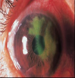 Case 20 year old male presents with a red painful eye Started that morning when he woke up reports a watery discharge, no itching, and is not a contact lens wearer SLE: See attached image with NaFl