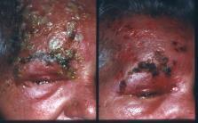 2. Reactivation Shingles () More often in the elderly and immunosuppressed (AIDS) Systemic work-up if Zoster in someone < 40 Can get shingles anywhere on the body Ophthalmicus (HZO) Shingles