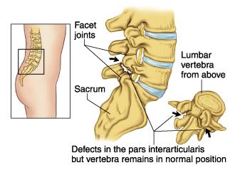 Lumbar spondylolysis Common condition Stress fracture of pars interarticularis Ballet, dance, gymnastics, figure