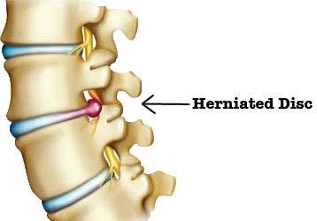 Disk herniation Relatively rare in children Weight lifting, gymnastics, wrestling and collision sports Back and leg pain