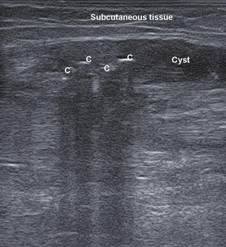 12 Subcutaneous cyst, showing lateral shadows due to refraction ( arrows) Reverberation Reverberation is an attenuation artifact generated by structures
