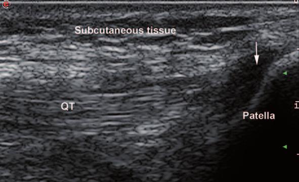 24 V. M. Vlad Fig. 2.2 Transverse view of empty bicipital groove ( arrows). The transducer is not perpendicular to the tendon. SubS subscapularis tendon evaluation.