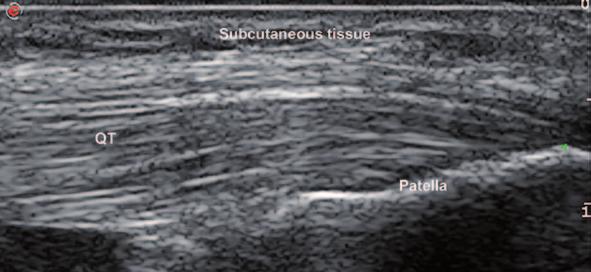 2 Pitfalls in Musculoskeletal Ultrasound 25 Fig. 2.4 Longitudinal view of quadriceps insertion on patella.