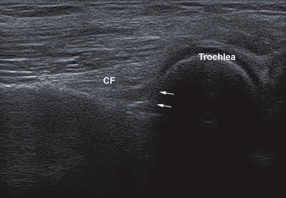 26 V. M. Vlad Fig. 2.6 Longitudinal view of the anterior elbow. Bone pseudodefect artifact is seen because of the transducer position, semitangential to the bone ( arrows). CF coronoid fossa Table 2.