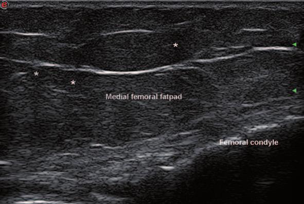 2 Pitfalls in Musculoskeletal Ultrasound 27 Fig. 2.7 Longitudinal view of the medial fat pad of the knee in an obese patient.