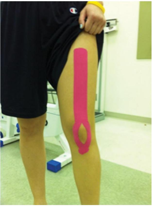 Other Treatments Patellar taping and bracing controversial Some evidence