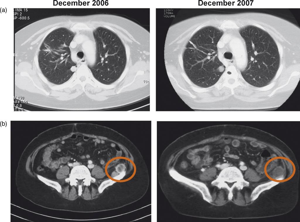 612 european urology supplements 7 (2008) 610 614 Fig. 1 Chest x-ray and computed tomography (CT) scan of metastases in (a) the lungs and (b) soft tissue at initial diagnosis and at 12-mo follow-up.