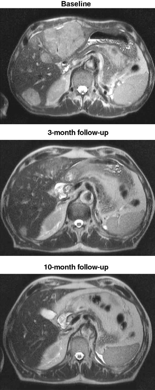 european urology supplements 7 (2008) 610 614 613 (from 10 cm to 6 cm). Further regression of metastases (from 6 cm to 2.5 cm) occurred after a total of 10 mo of treatment with sunitinib (Fig. 2).
