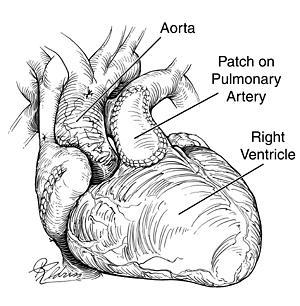 of right ventricular