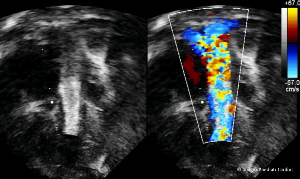 The echocardiographic appearance of the stent is shown in figures 9 and 10. Figure 9: Echocardiographic appearance of stented RVOT in apical four chamber view.