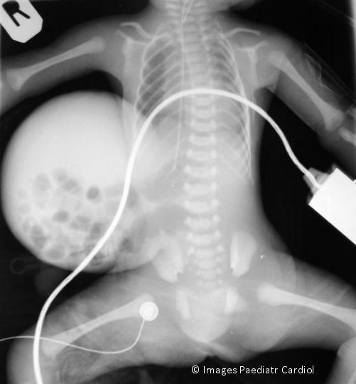 Figure 11: Chest and abdominal x-ray showing large omphalocele Karyotype was normal.