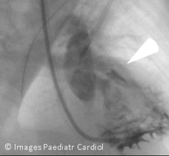 Figure 12: Pre-stent angiogram. Arrow indicates site of RVOTO.