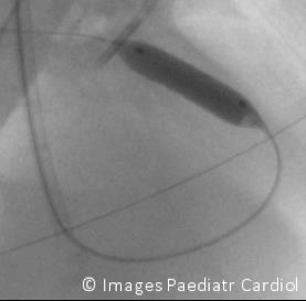 Figure 14: Post-stent angiogram.