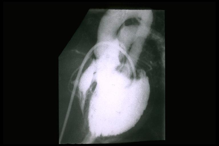 Single Ventricle LV angiography in a patient with