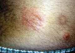 Case 5 Weeping Blisters A 25-year-old male presents with an itchy rash on the right side of his back, consisting of weeping blisters grouped in a linear fashion. a. Psoriasis b. Insect bites c.