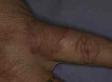 Case 6 A Violaceous Plaque A 45-year-old diabetic female, with family history of psoriasis, presents with an asymptomatic annular plaque of the right index finger.