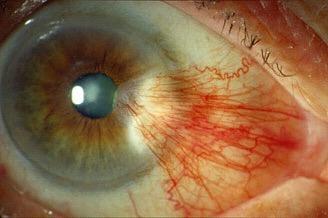Pterygium Only require surgery if